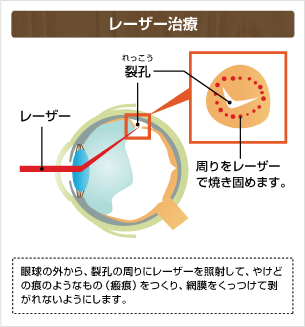 レーザー治療