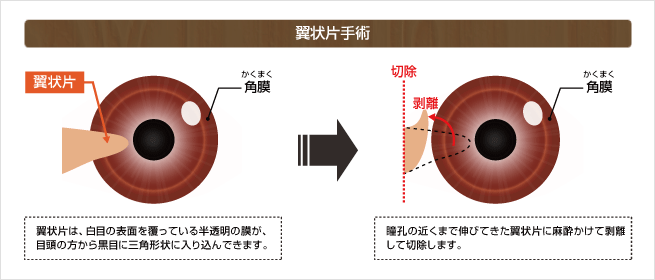 翼状片手術