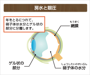 網膜剥離の原因