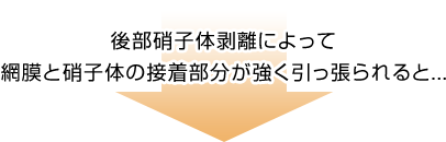 網膜剥離の原因